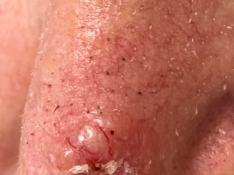 Ejemplo de lesiu00f3n tu00edpica en una localizaciu00f3n muy frecuente, la punta nasal.